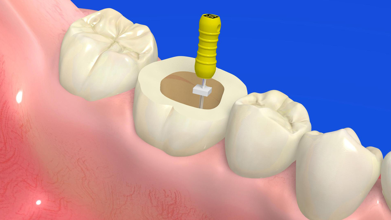 知立市の虫歯の治療