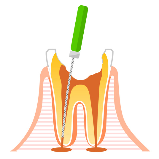 知立市の虫歯の治療