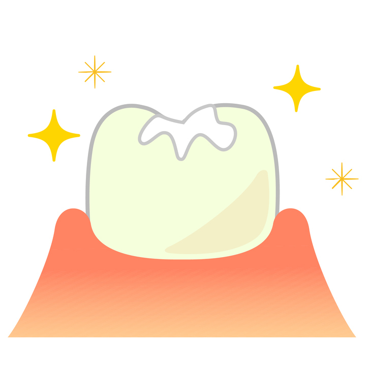 知立市の虫歯の治療