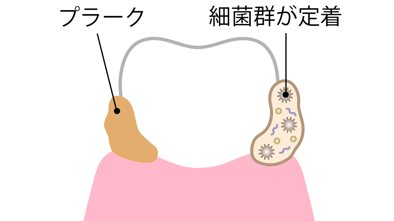 知立市で歯周病が進んだ方へ