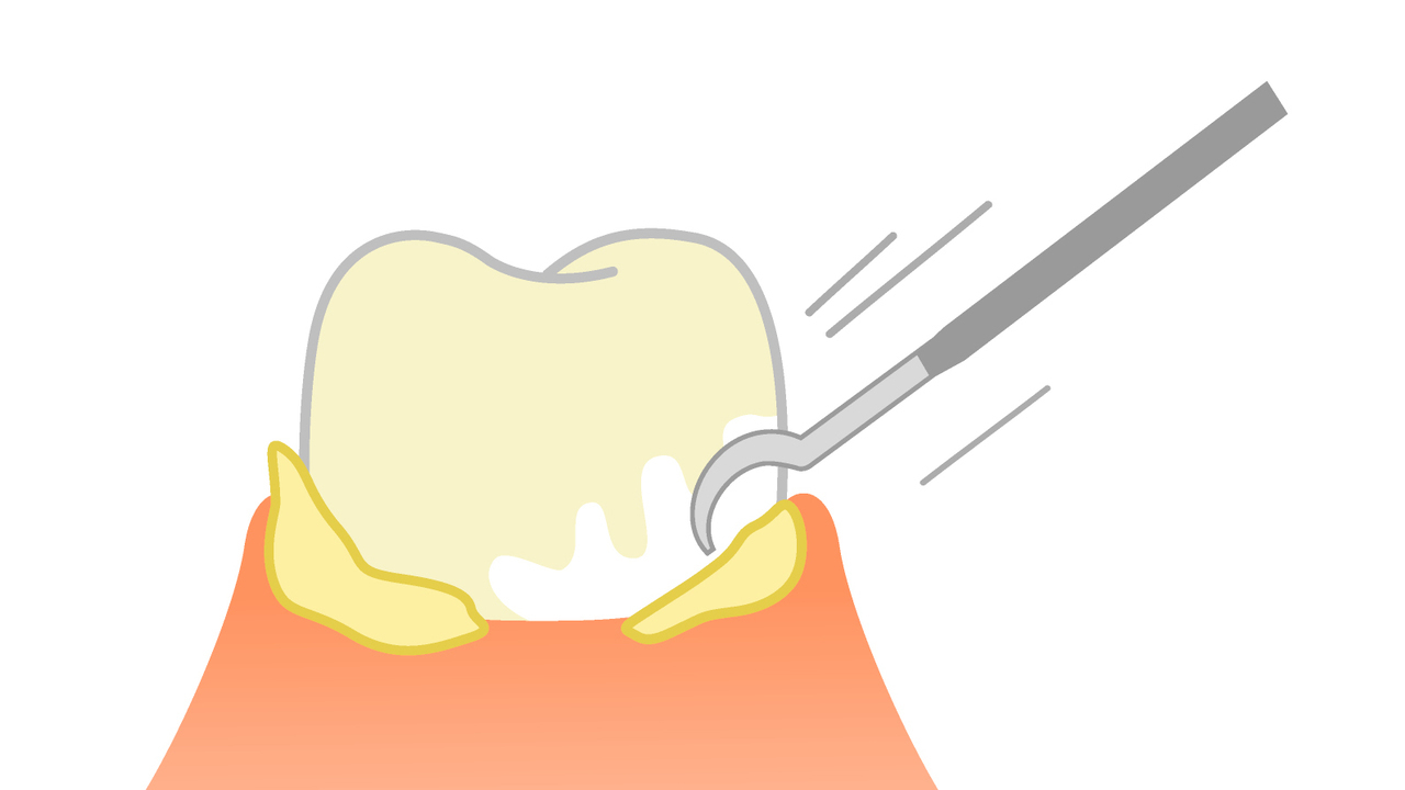 知立市の歯茎の中のクリーニング（SRP）