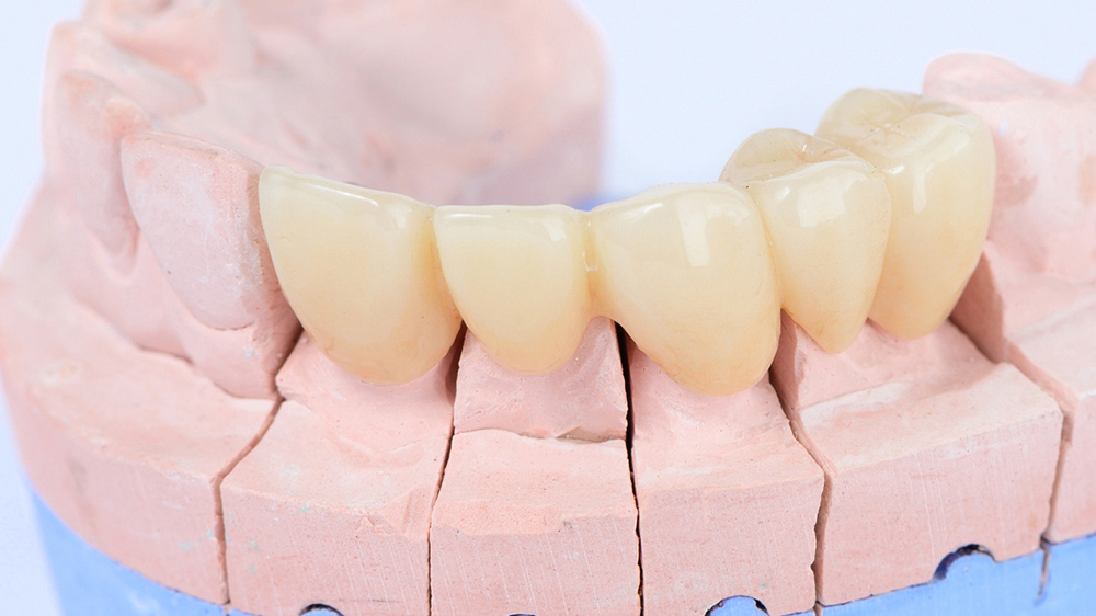 知立市のジルコニア治療