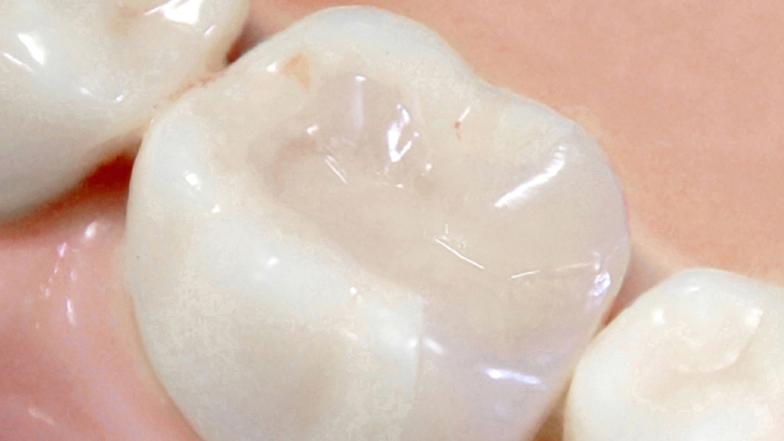 知立市の虫歯の治療