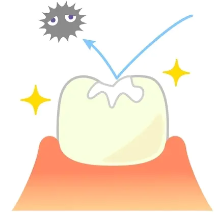 知立市のシーラント治療