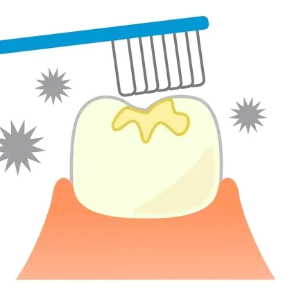 知立市のシーラント治療