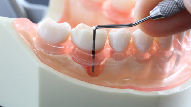 歯茎の中のクリーニング（SRP）