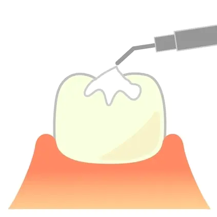知立市のシーラント治療