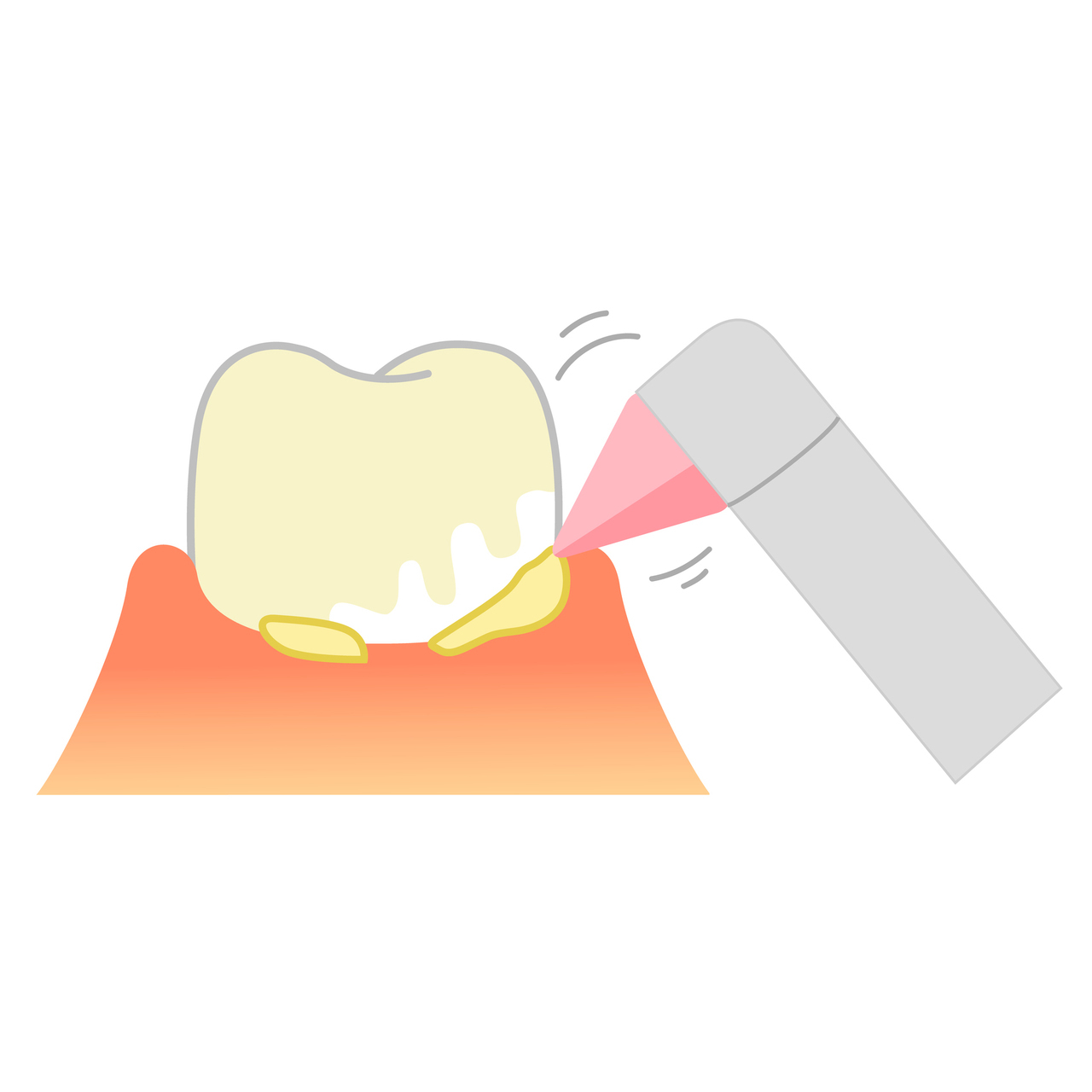 知立市の予防歯科・定期検診