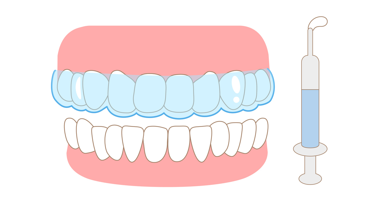 知立市のホームホワイトニング